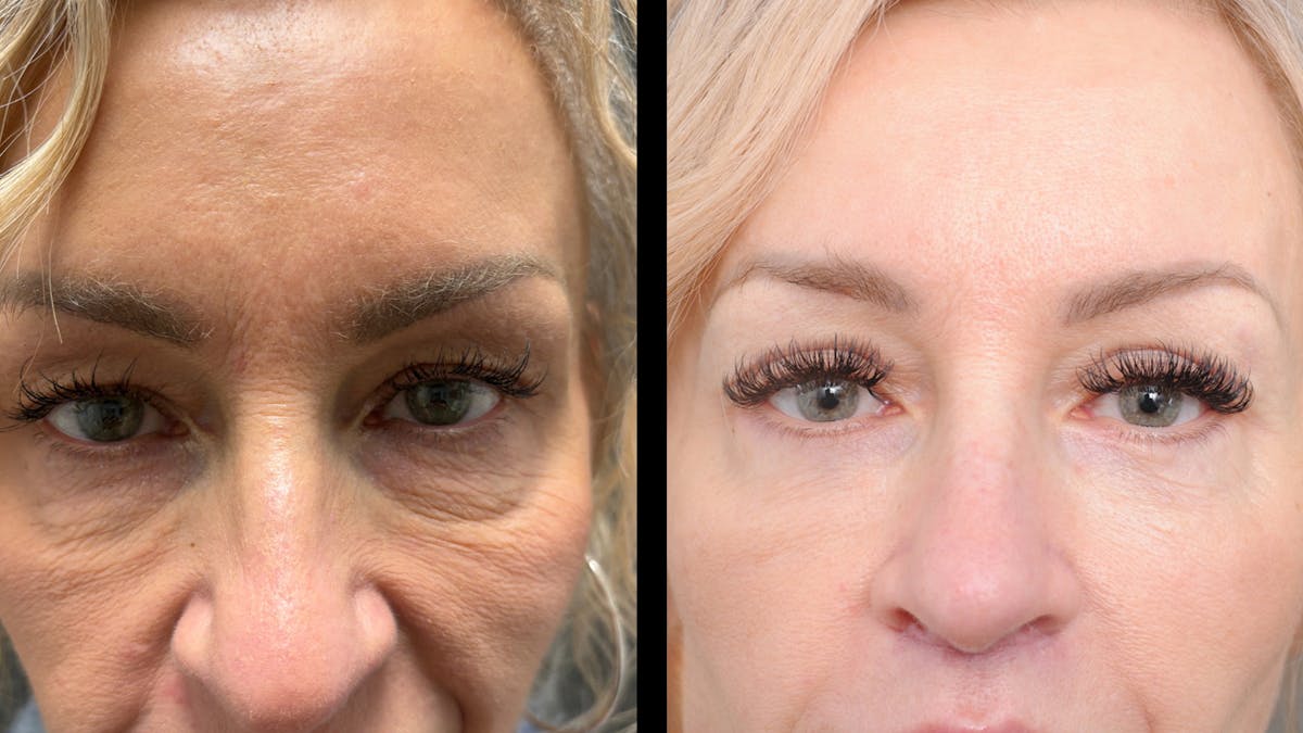 Lower Eyelid Surgery Before & After Gallery - Patient 232754 - Image 8