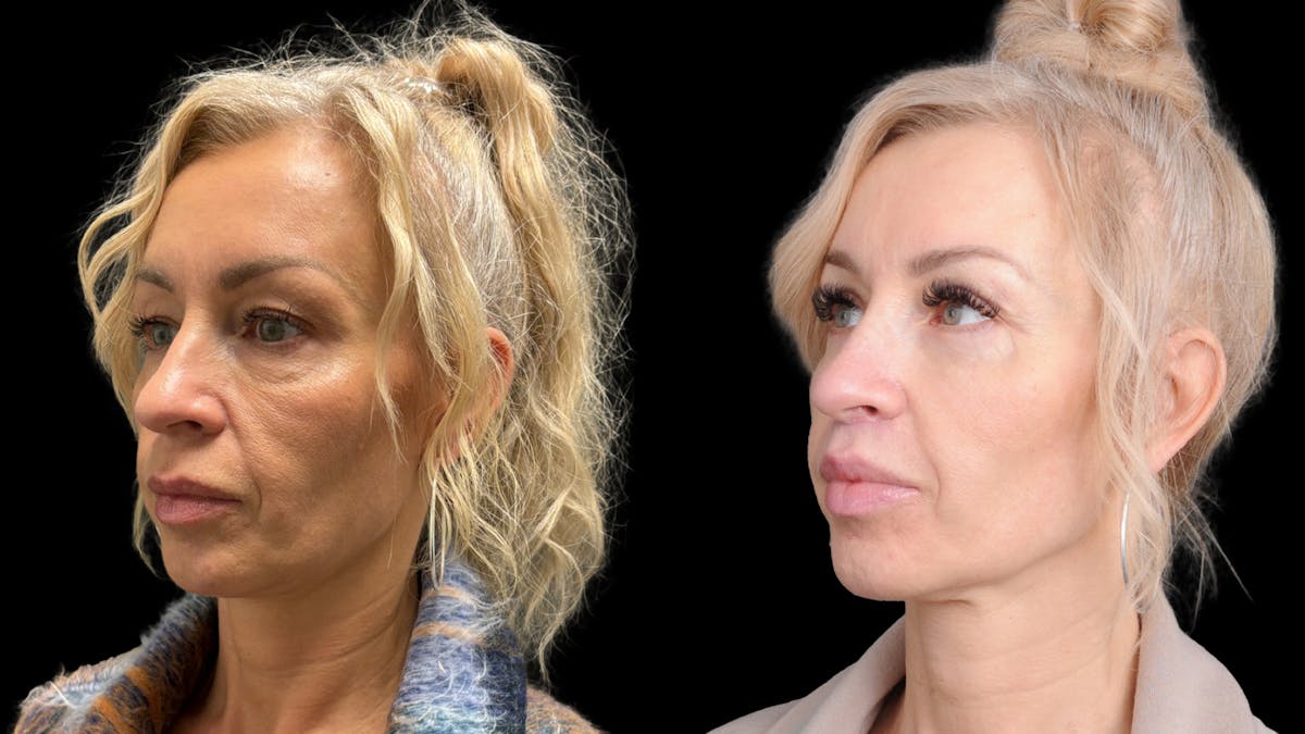 Lower Eyelid Surgery Before & After Gallery - Patient 232754 - Image 1