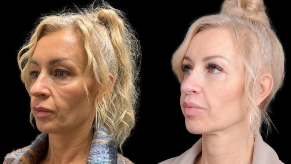 Lower Eyelid Surgery Before & After Gallery - Patient 232754 - Image 1