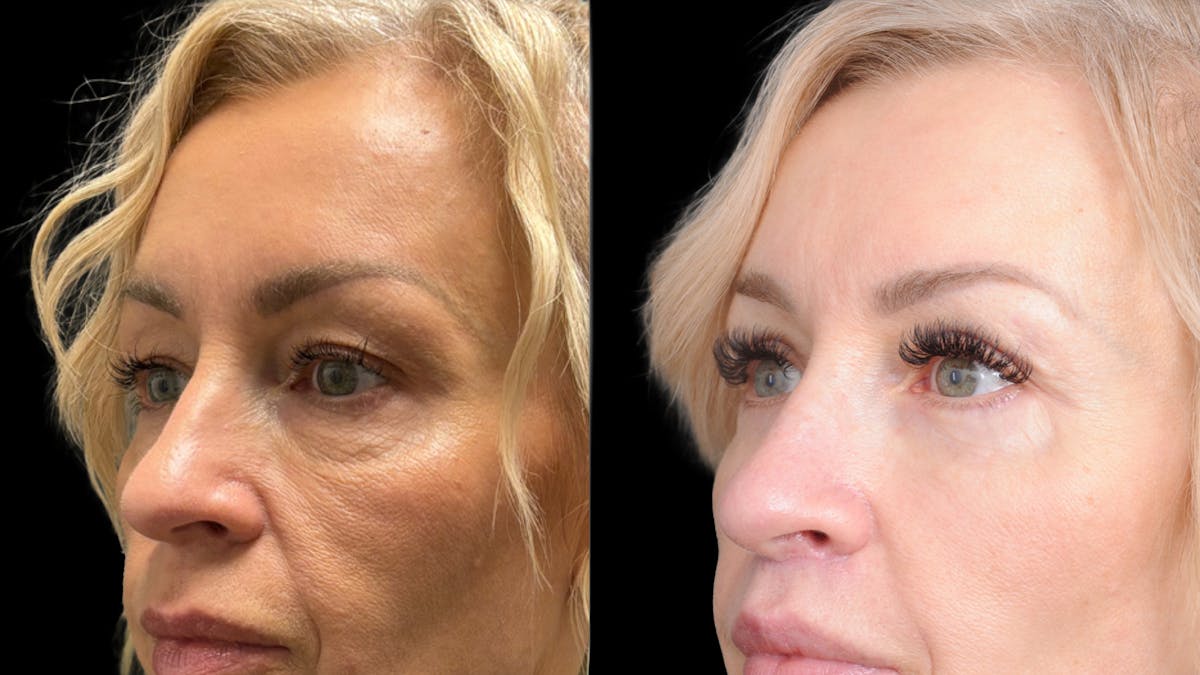 Lower Eyelid Surgery Before & After Gallery - Patient 232754 - Image 7