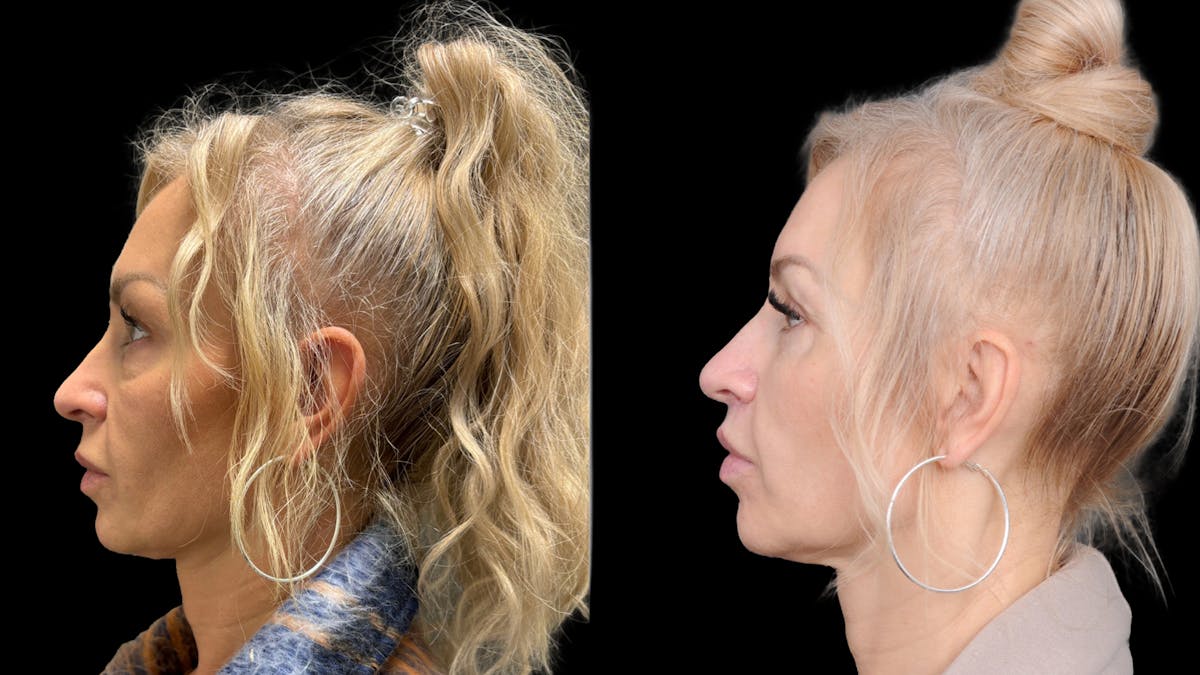Lower Eyelid Surgery Before & After Gallery - Patient 232754 - Image 2