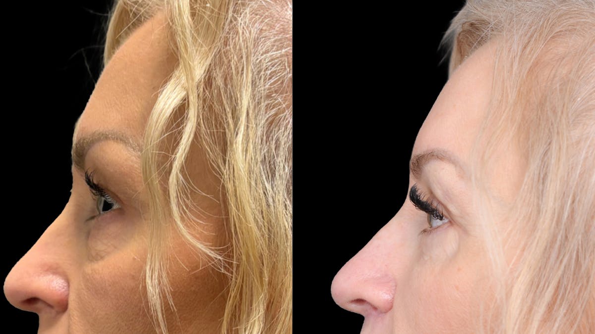 Lower Eyelid Surgery Before & After Gallery - Patient 232754 - Image 4