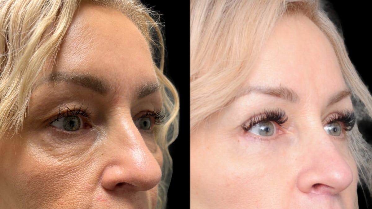 Lower Eyelid Surgery Before & After Gallery - Patient 232754 - Image 9