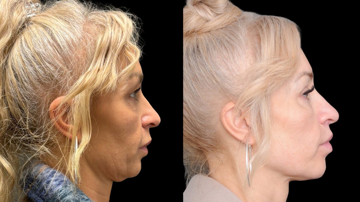 Lower Eyelid Surgery Before & After Gallery - Patient 232754 - Image 3