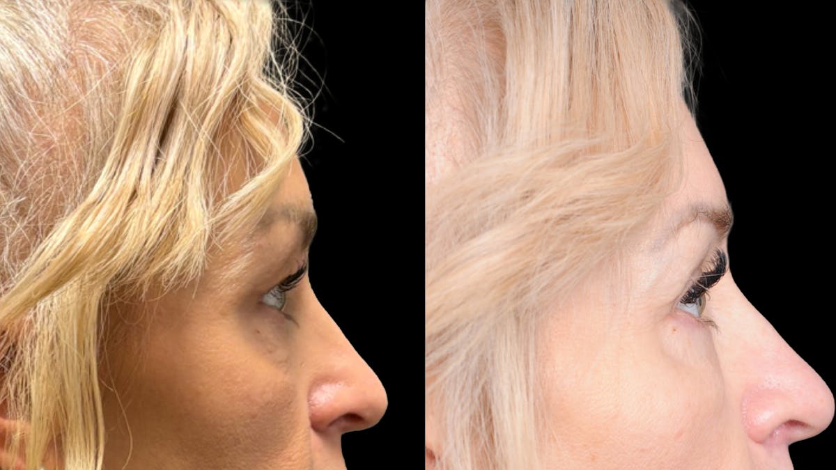 Lower Eyelid Surgery Before & After Gallery - Patient 232754 - Image 10