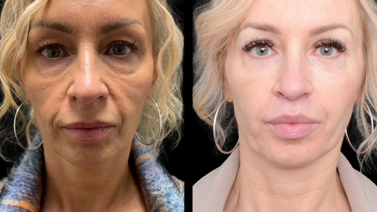 Lower Eyelid Surgery Before & After Gallery - Patient 232754 - Image 6