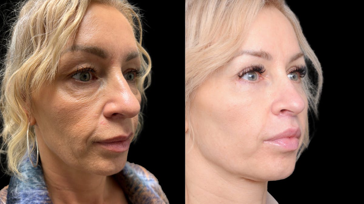 Lower Eyelid Surgery Before & After Gallery - Patient 232754 - Image 5