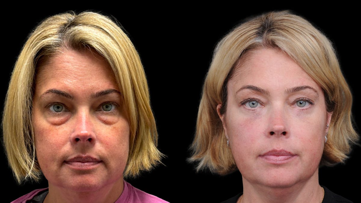 Lower Eyelid Surgery Before & After Gallery - Patient 245007 - Image 1
