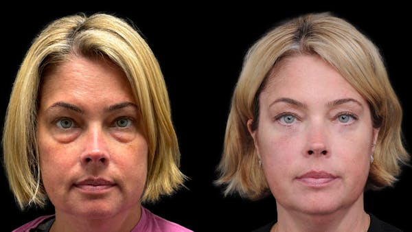 Lower Eyelid Surgery Before & After Gallery - Patient 245007 - Image 1