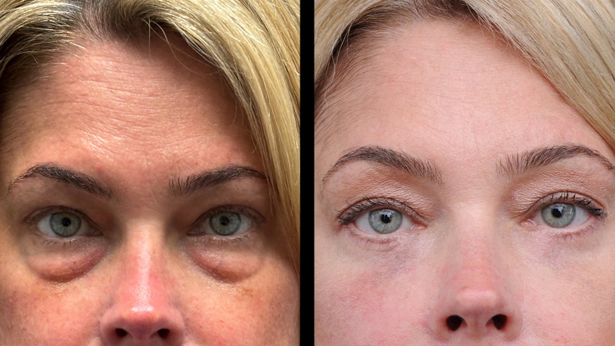 Lower Eyelid Surgery Before & After Gallery - Patient 245007 - Image 2