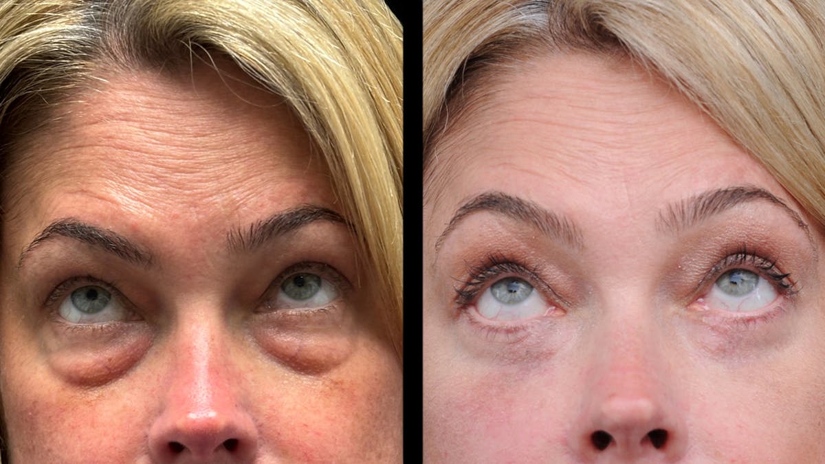 Lower Eyelid Surgery Before & After Gallery - Patient 245007 - Image 3