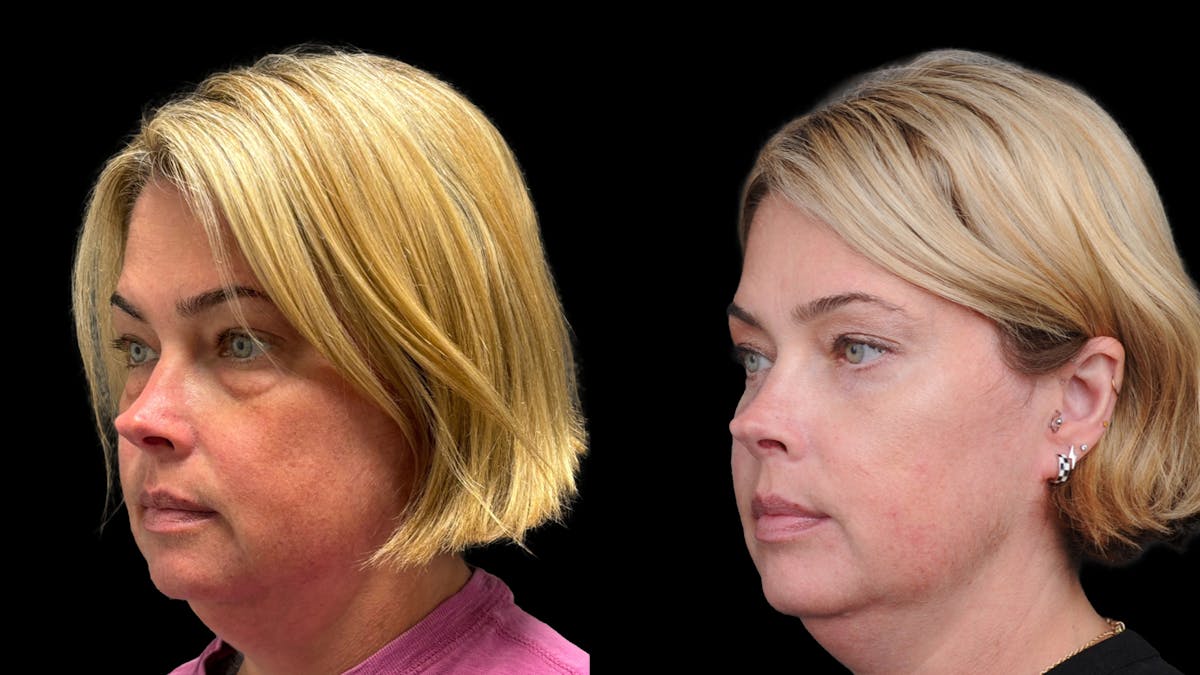Lower Eyelid Surgery Before & After Gallery - Patient 245007 - Image 4