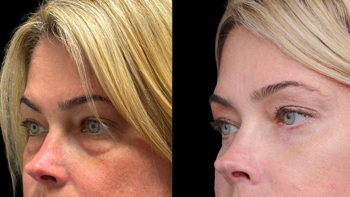 Lower Eyelid Surgery Before & After Gallery - Patient 245007 - Image 5
