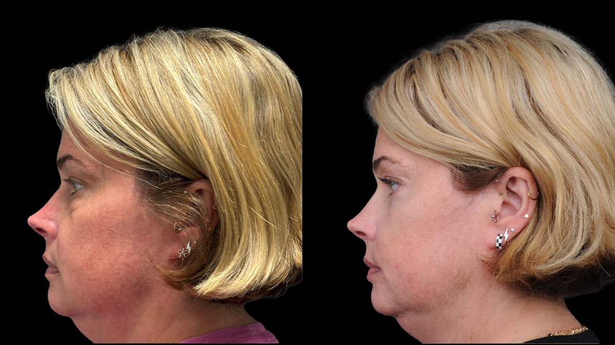 Lower Eyelid Surgery Before & After Gallery - Patient 245007 - Image 6