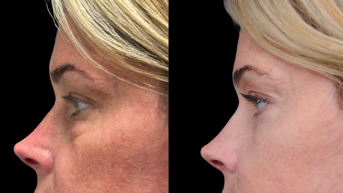 Lower Eyelid Surgery Before & After Gallery - Patient 245007 - Image 7