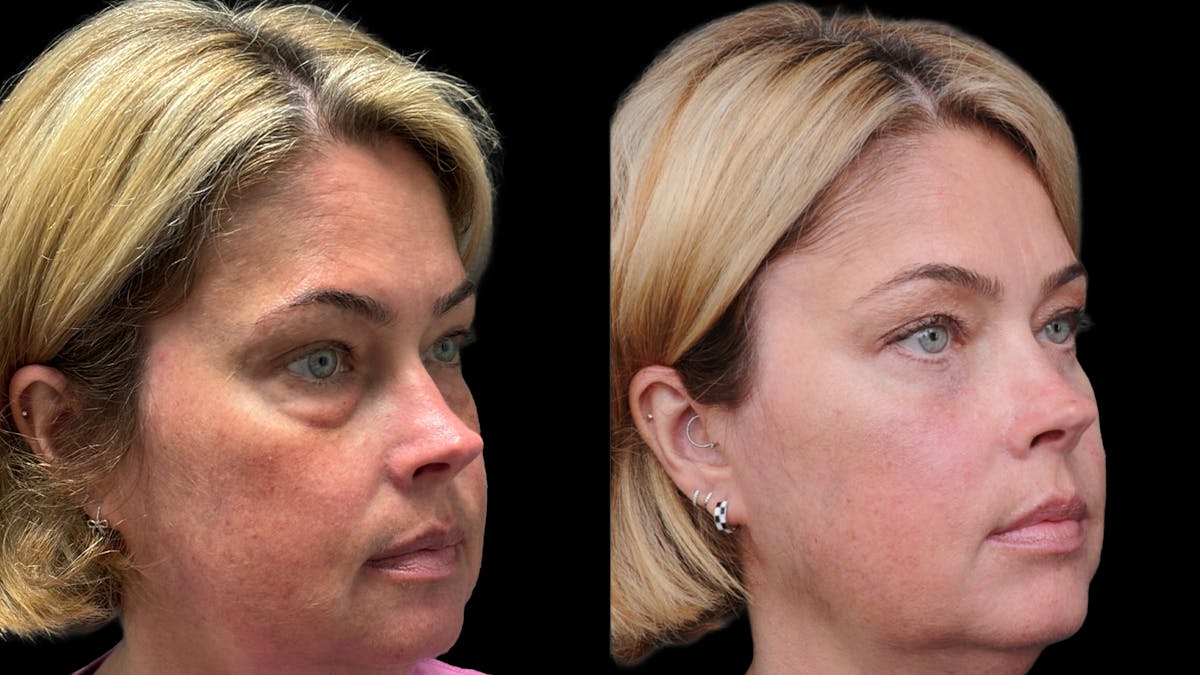 Lower Eyelid Surgery Before & After Gallery - Patient 245007 - Image 8