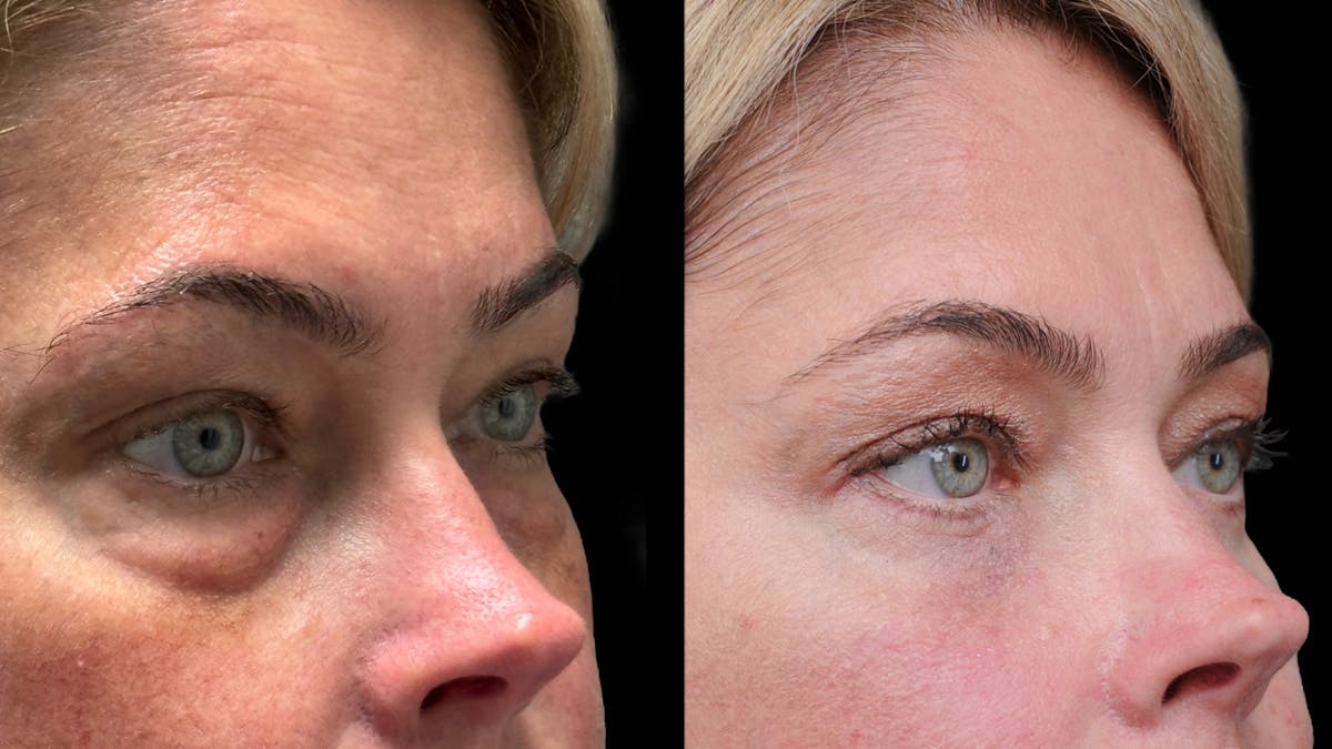 Lower Eyelid Surgery Before & After Gallery - Patient 245007 - Image 9