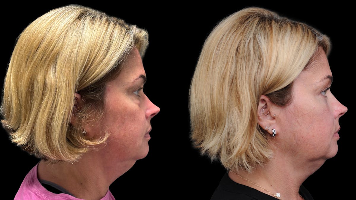 Lower Eyelid Surgery Before & After Gallery - Patient 245007 - Image 10