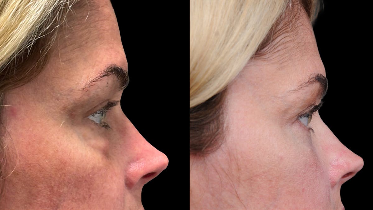 Lower Eyelid Surgery Before & After Gallery - Patient 245007 - Image 11