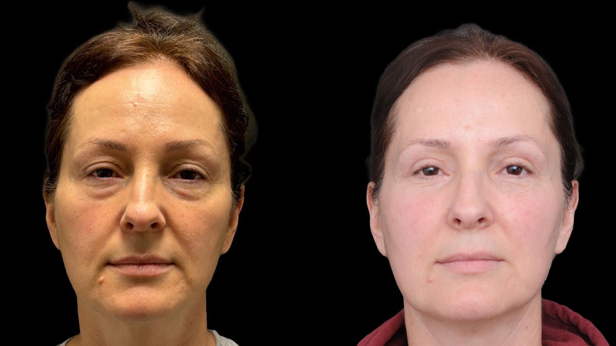 Lower Eyelid Surgery Before & After Gallery - Patient 283326 - Image 2