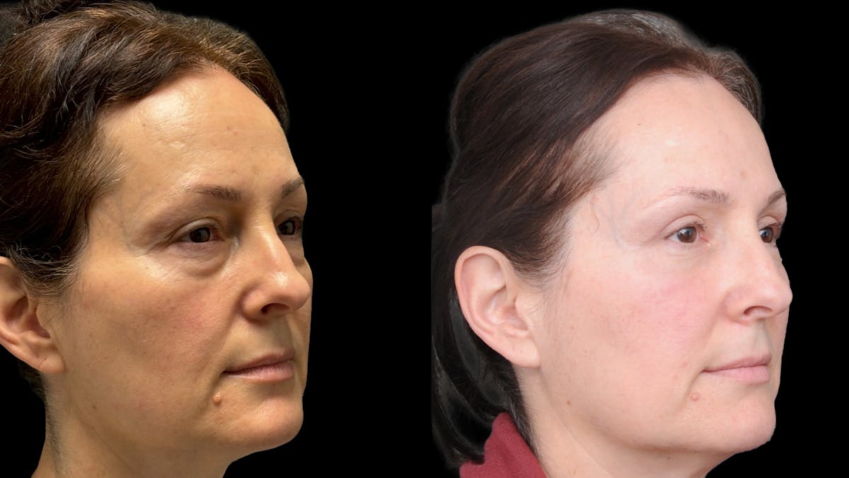 Lower Eyelid Surgery Before & After Gallery - Patient 283326 - Image 3