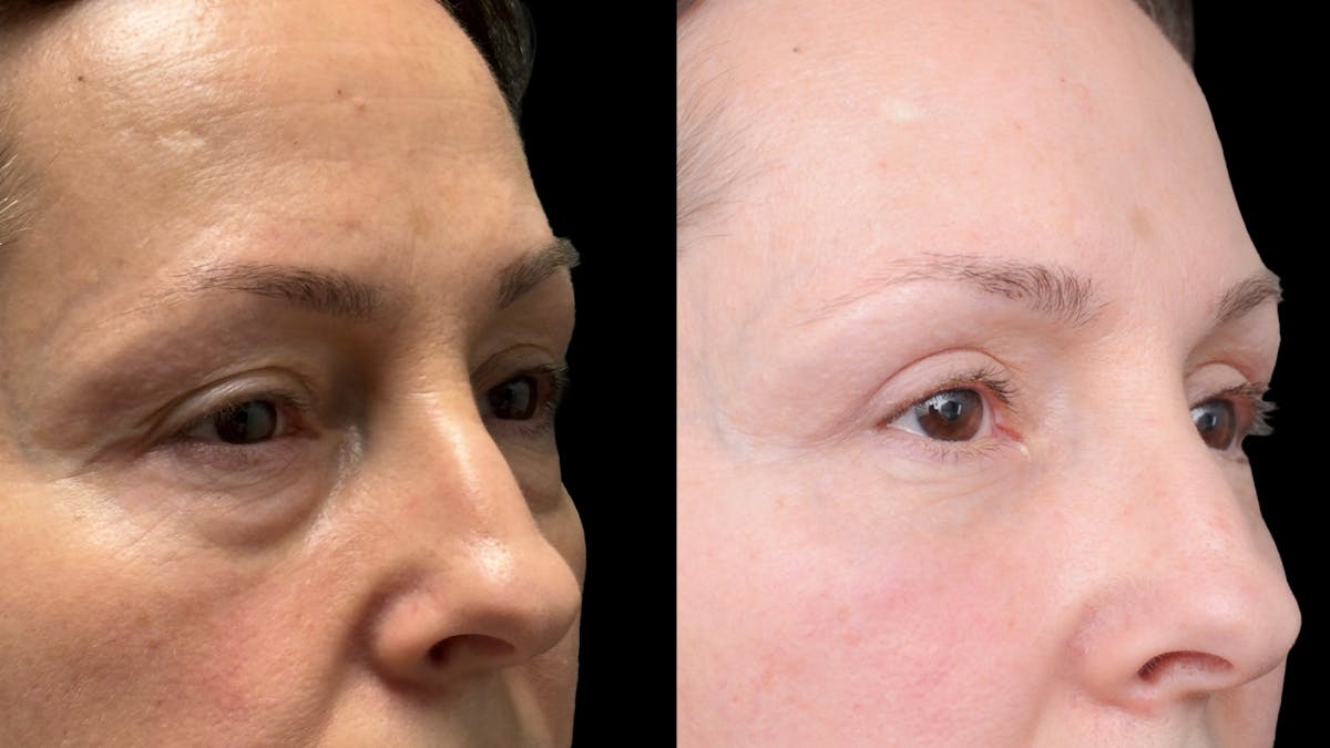 Lower Eyelid Surgery Before & After Gallery - Patient 283326 - Image 7