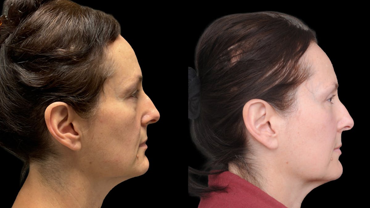 Lower Eyelid Surgery Before & After Gallery - Patient 283326 - Image 4