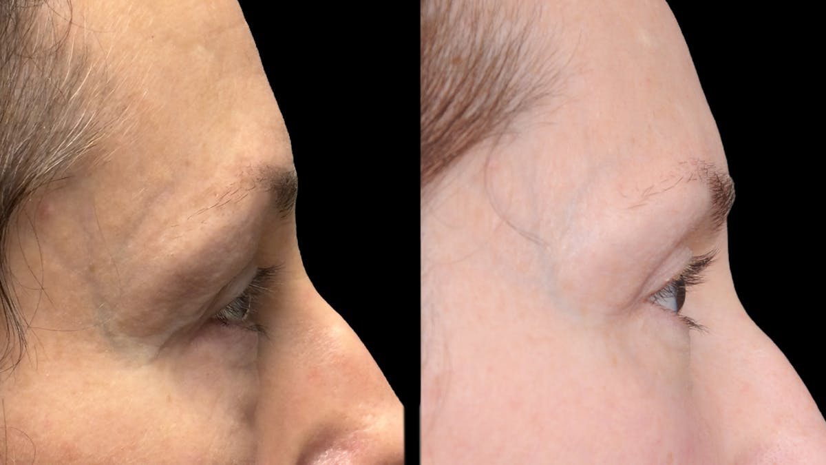 Lower Eyelid Surgery Before & After Gallery - Patient 283326 - Image 8