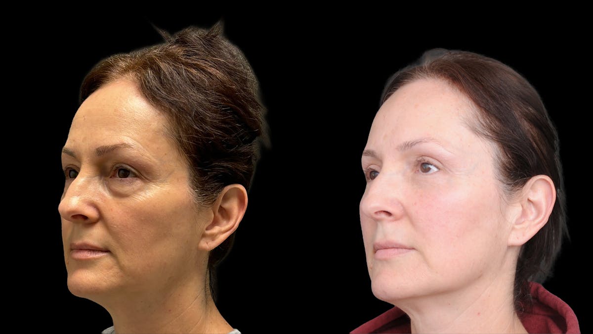 Lower Eyelid Surgery Before & After Gallery - Patient 283326 - Image 1