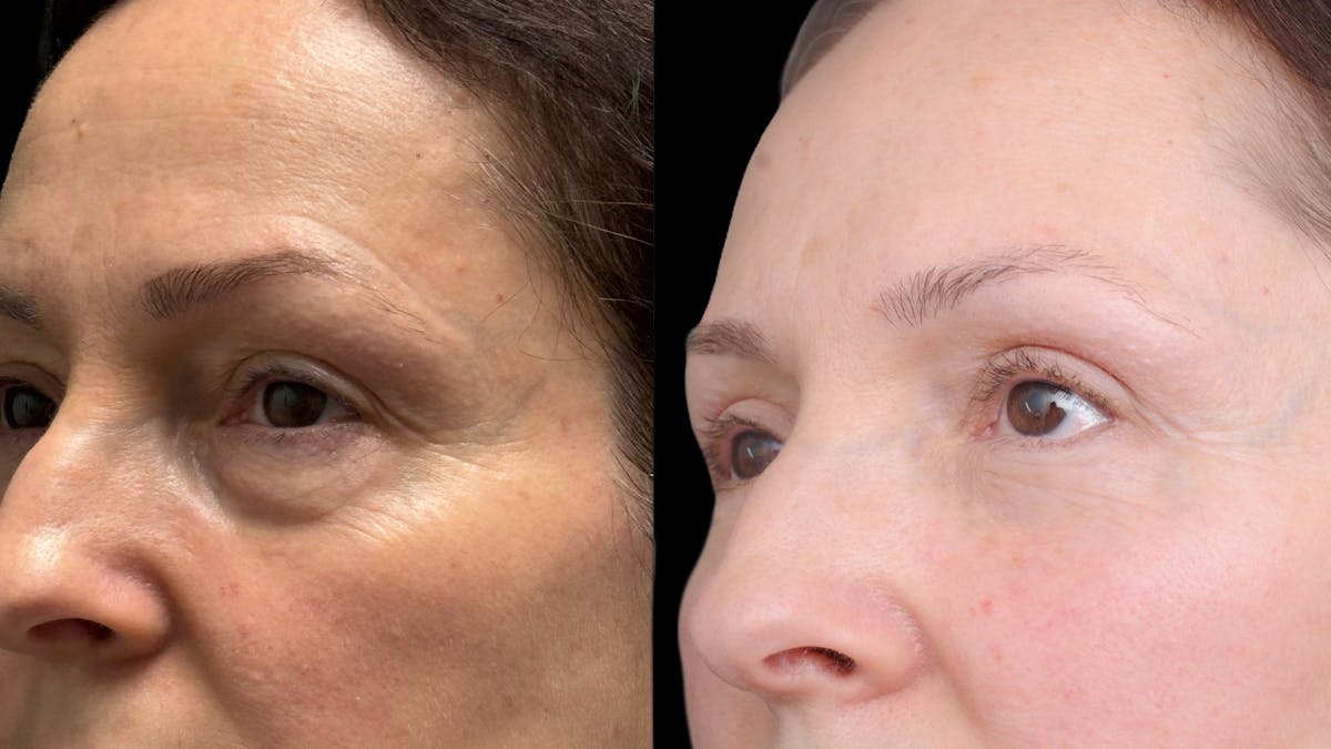 Lower Eyelid Surgery Before & After Gallery - Patient 283326 - Image 9