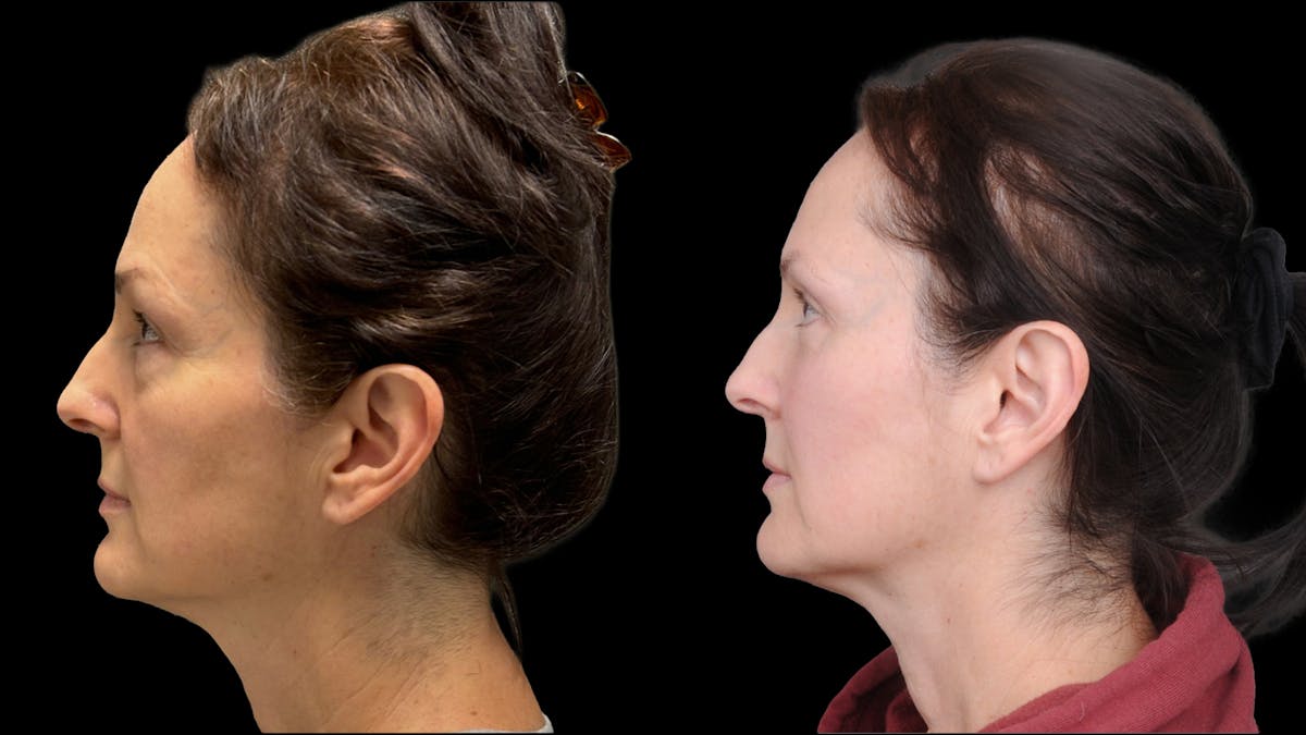 Lower Eyelid Surgery Before & After Gallery - Patient 283326 - Image 5