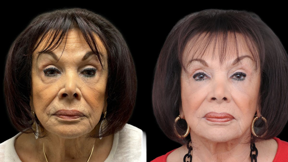 Lower Eyelid Surgery Before & After Gallery - Patient 270126 - Image 2