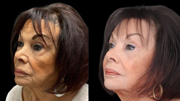 Lower Eyelid Surgery Before & After Gallery - Patient 270126 - Image 1