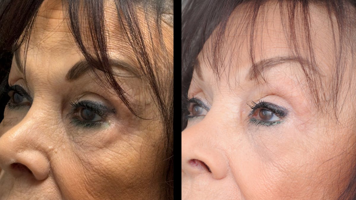 Lower Eyelid Surgery Before & After Gallery - Patient 270126 - Image 7