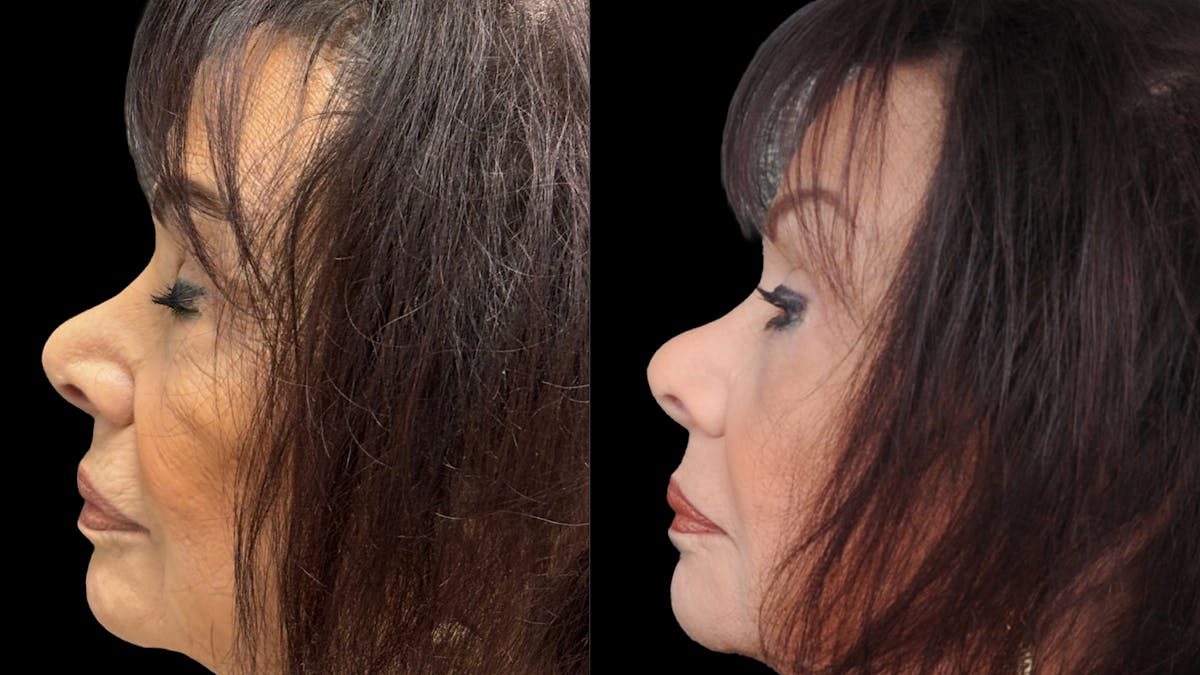 Lower Eyelid Surgery Before & After Gallery - Patient 270126 - Image 3