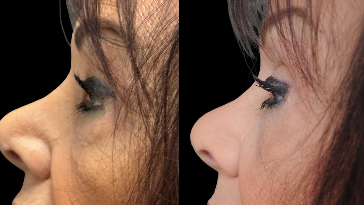 Lower Eyelid Surgery Before & After Gallery - Patient 270126 - Image 8