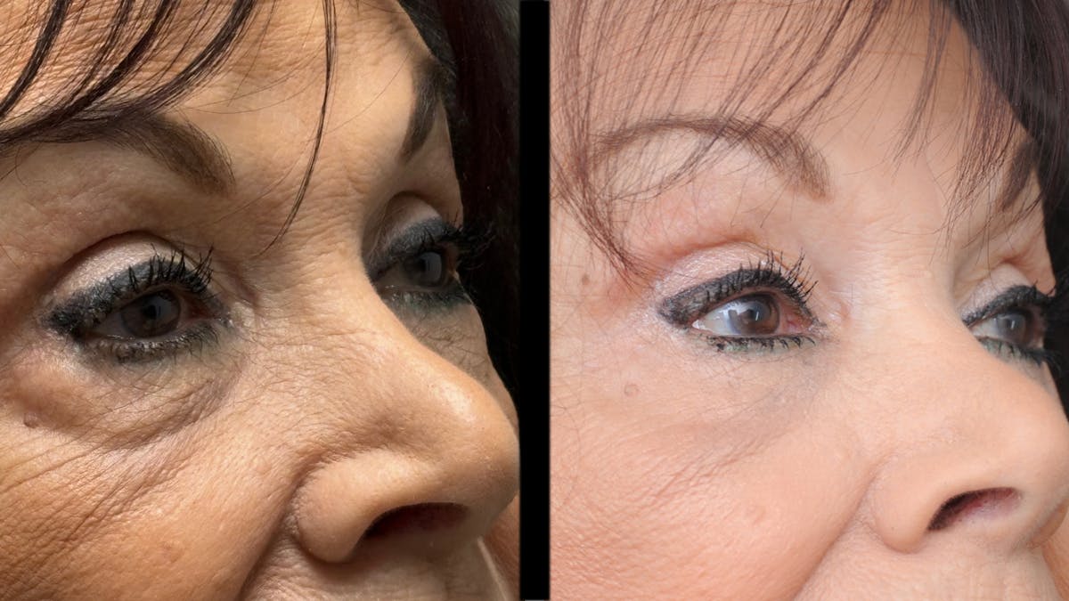 Lower Eyelid Surgery Before & After Gallery - Patient 270126 - Image 9
