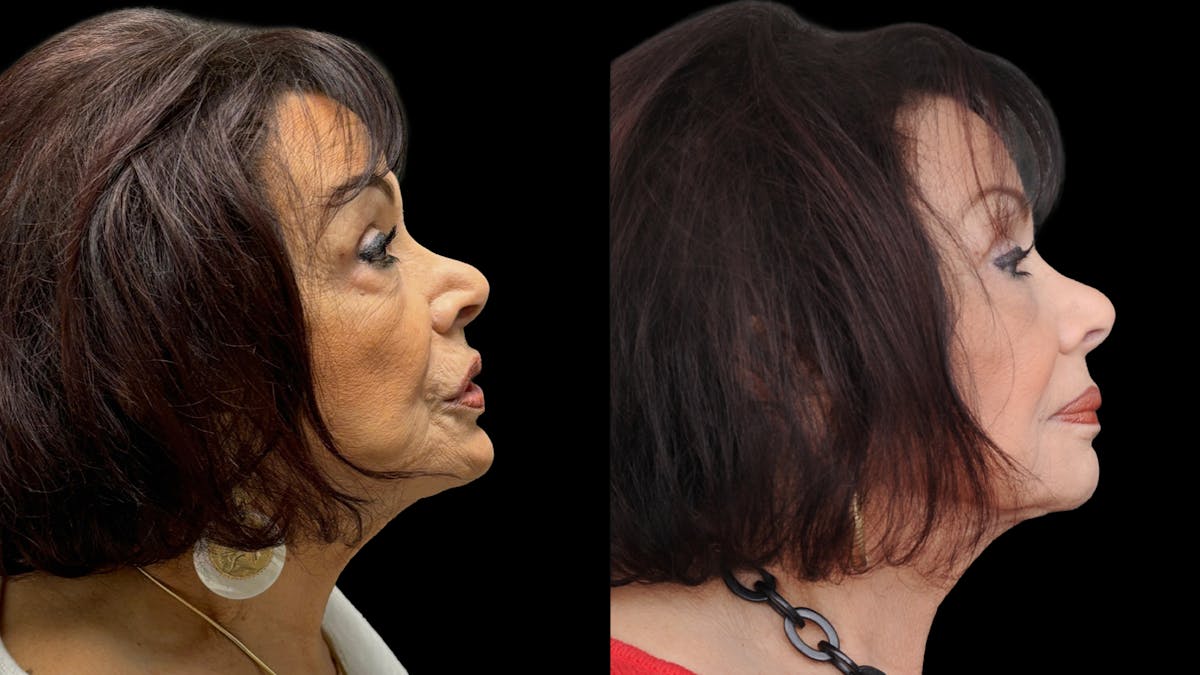 Lower Eyelid Surgery Before & After Gallery - Patient 270126 - Image 5