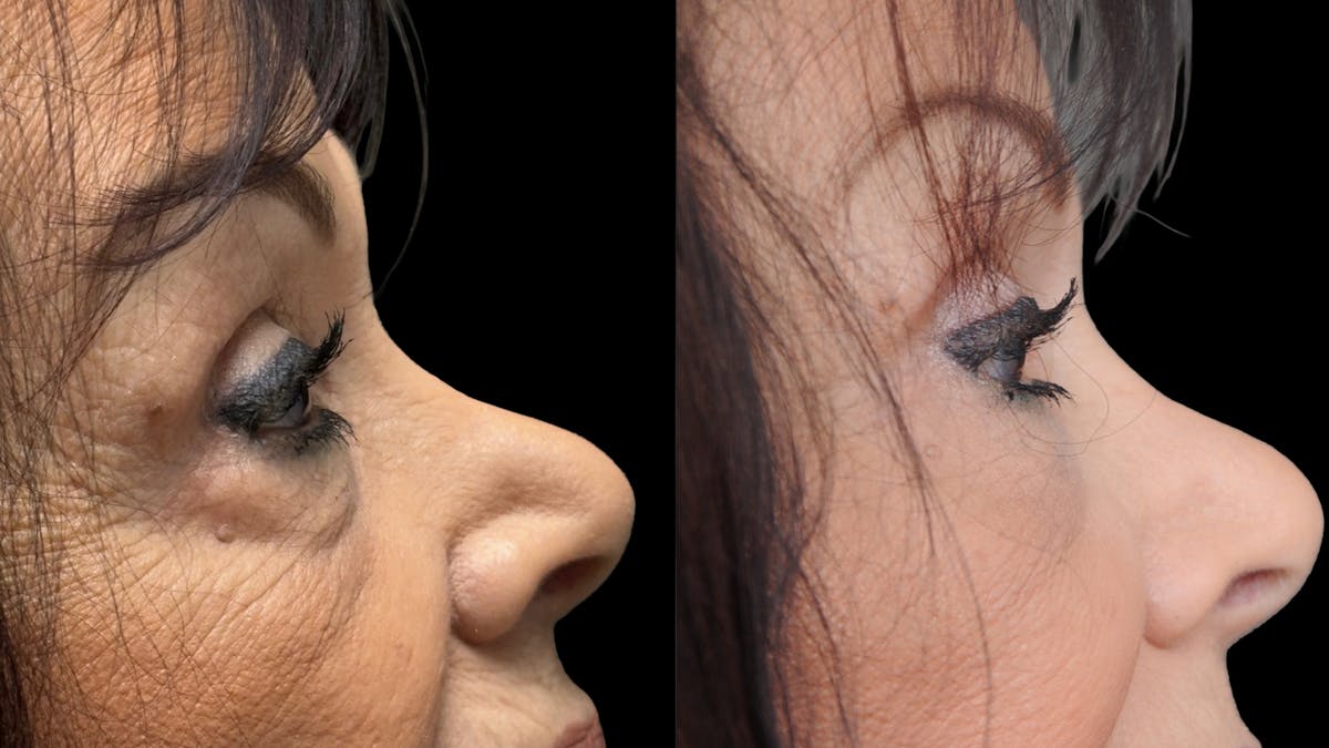 Lower Eyelid Surgery Before & After Gallery - Patient 270126 - Image 10