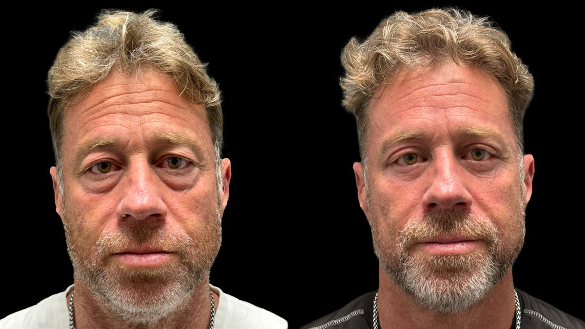 Lower Eyelid Surgery Before & After Gallery - Patient 359692 - Image 2