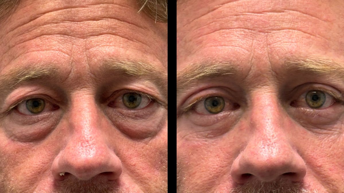 Lower Eyelid Surgery Before & After Gallery - Patient 359692 - Image 6