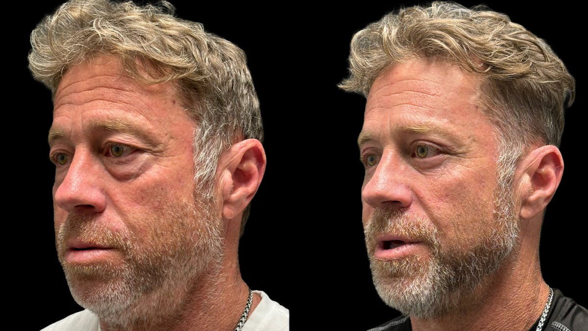 Lower Eyelid Surgery Before & After Gallery - Patient 359692 - Image 1