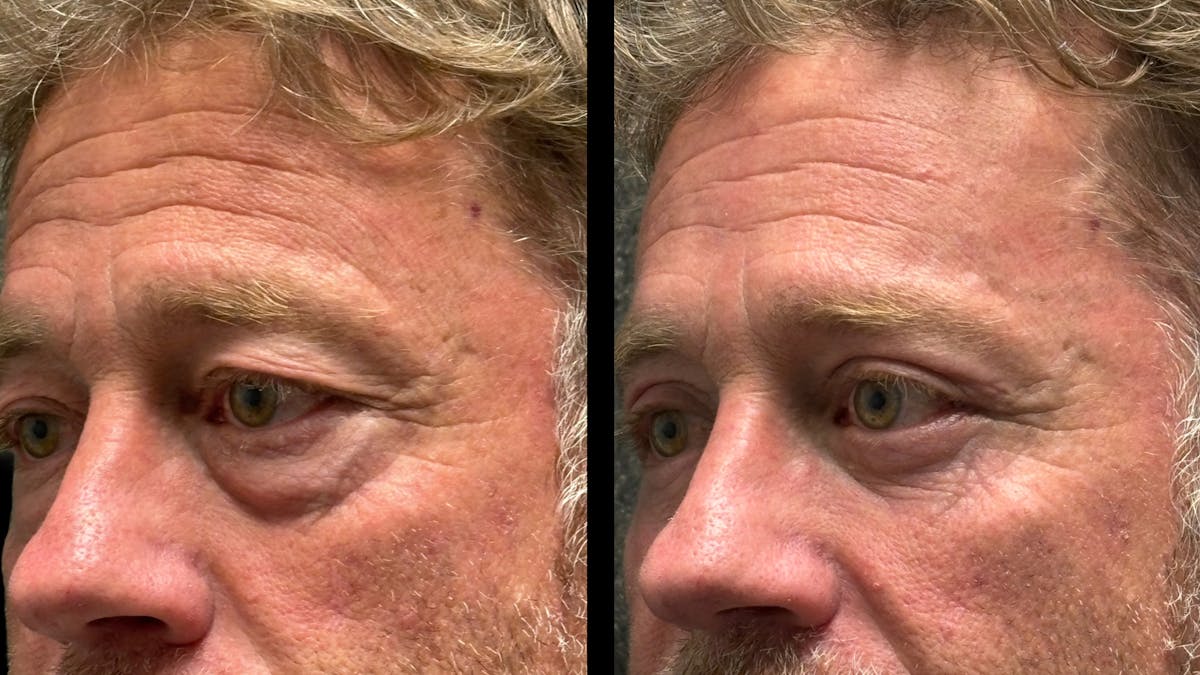 Lower Eyelid Surgery Before & After Gallery - Patient 359692 - Image 7