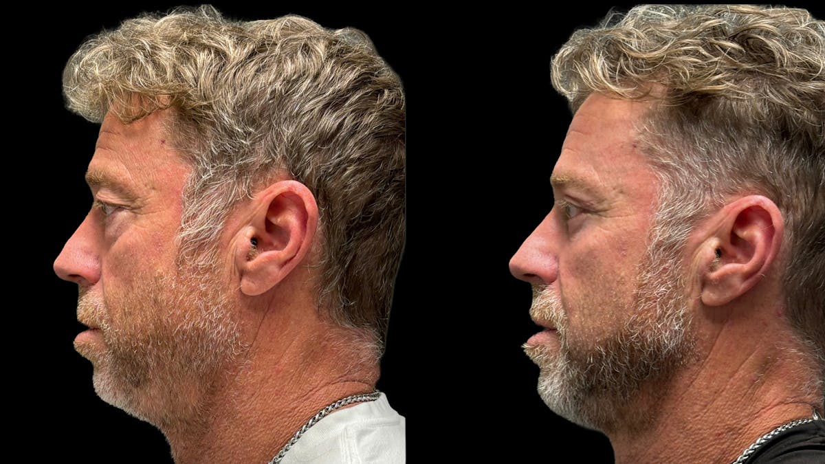Lower Eyelid Surgery Before & After Gallery - Patient 359692 - Image 3