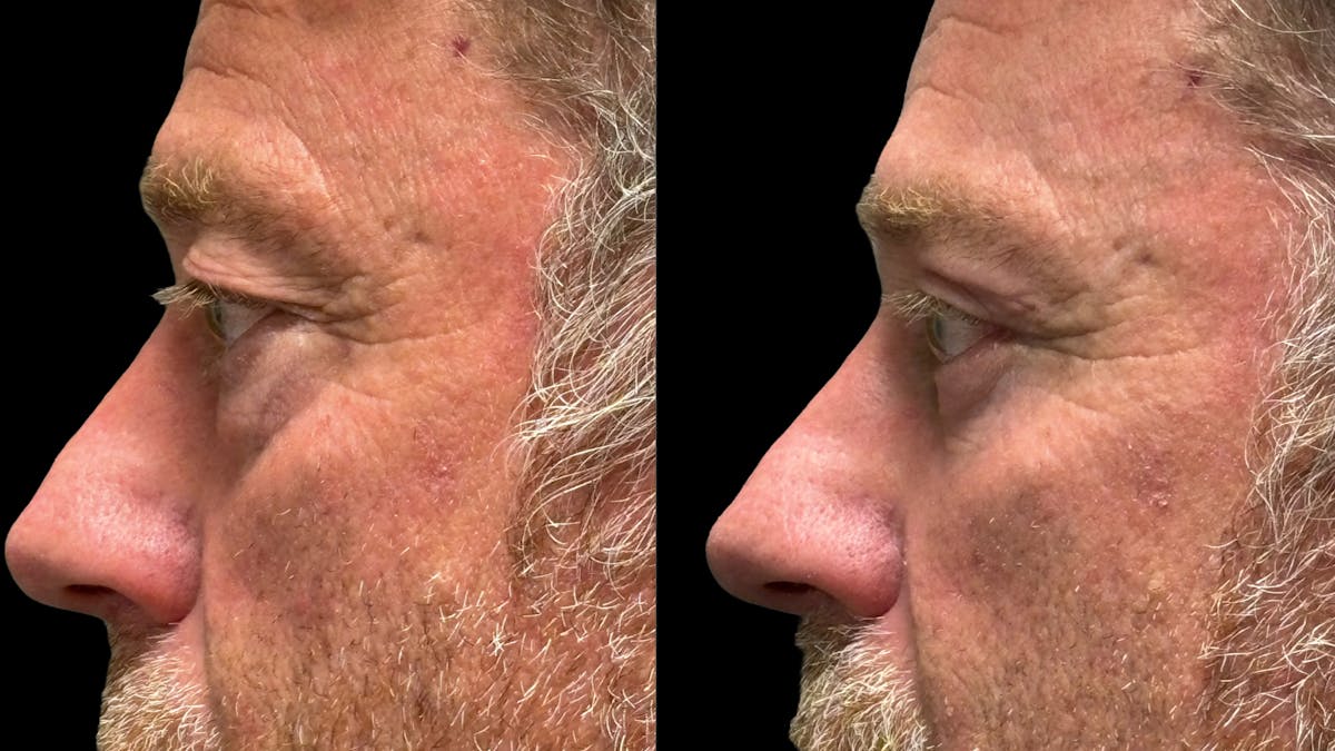 Lower Eyelid Surgery Before & After Gallery - Patient 359692 - Image 9