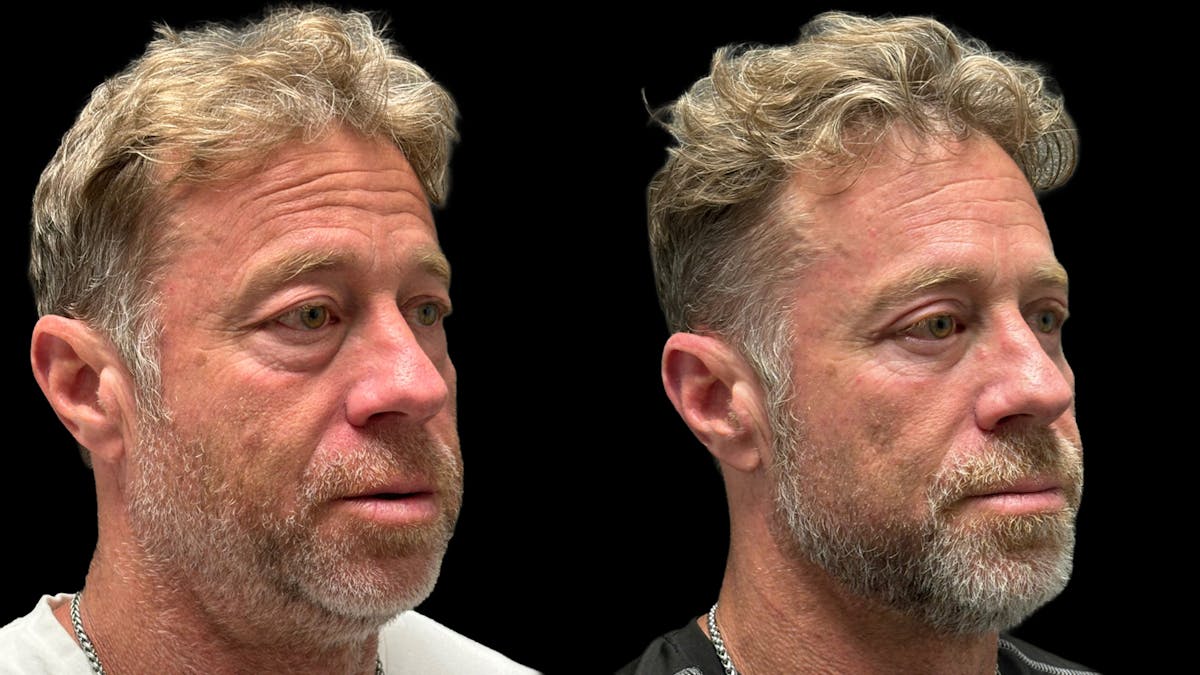 Lower Eyelid Surgery Before & After Gallery - Patient 359692 - Image 4