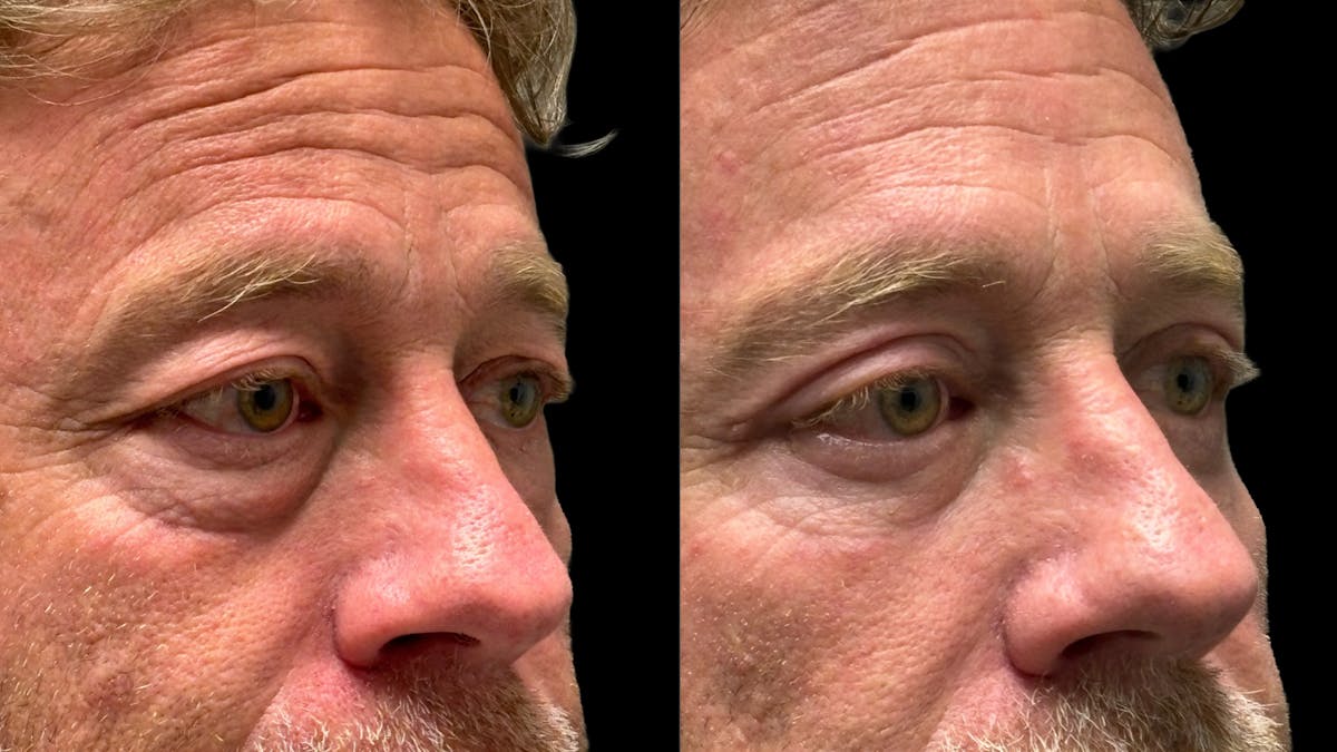 Lower Eyelid Surgery Before & After Gallery - Patient 359692 - Image 10