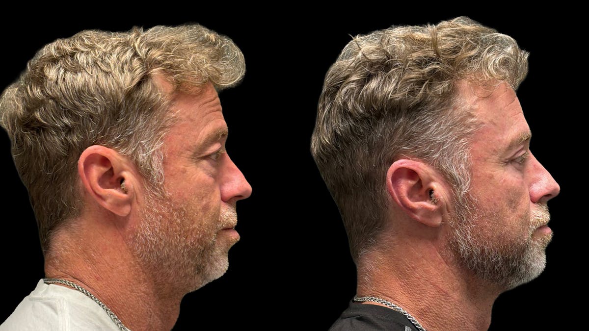 Lower Eyelid Surgery Before & After Gallery - Patient 359692 - Image 5