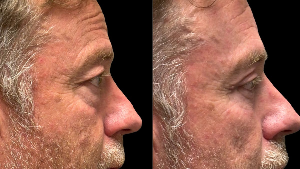 Lower Eyelid Surgery Before & After Gallery - Patient 359692 - Image 11