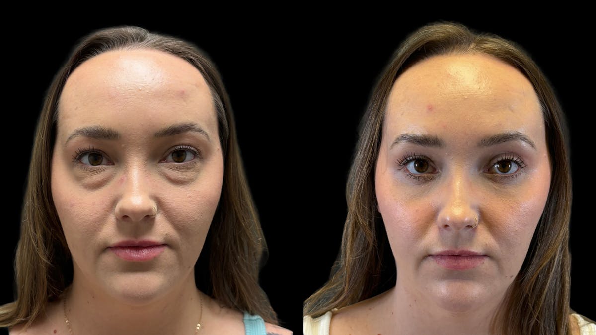 Lower Eyelid Surgery Before & After Gallery - Patient 226872 - Image 2